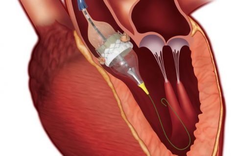 Cirugía Valvular Médicos en Merida