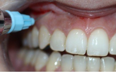 Anestesia en el dentista