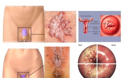 Infeccion por VPH