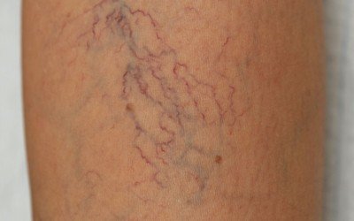 Grados de varices