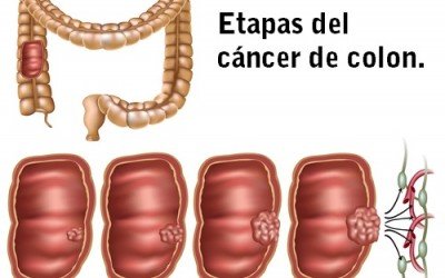 Señales y síntomas del cáncer colorrectal