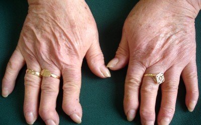 Artritis reumatoide