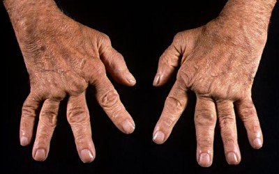 Artritis reumatoide