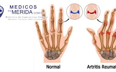 Artritis reumatoide