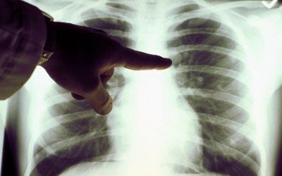 Cáncer de pulmones