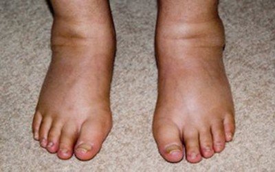 Consejos para prevenir los problemas circulatorios y suavizar sus síntomas en piernas