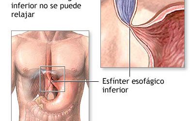 Acalasia