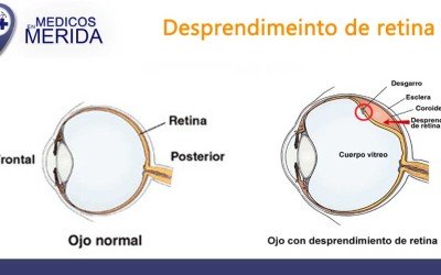 Desprendimiento de retina
