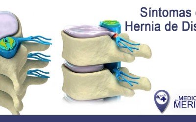 ¿Como saber si tengo una hernia de disco?