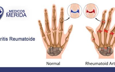 Artritis reumatoide