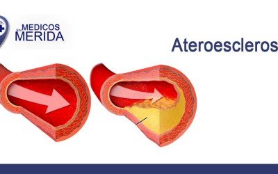 Ateroesclerosis