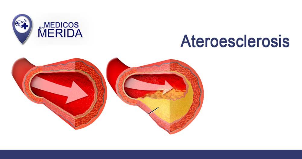 Ateroesclerosis