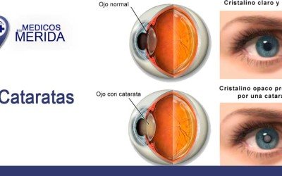 Cataratas