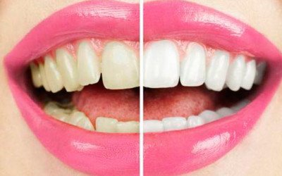 Los riesgos de blanquearse los dientes en casa o el salón de belleza