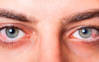 Agentes químicos y actividades cotidianas pueden dañar los ojos
