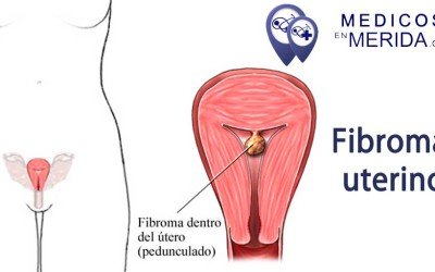 Fibromas uterinos: diagnóstico y tratamiento