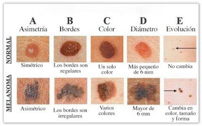 Melanoma: ¿Cómo prevenirlo?