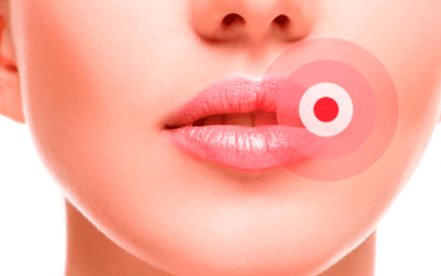 Tipos de herpes