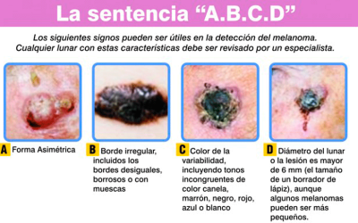 Cómo identificar un melanoma