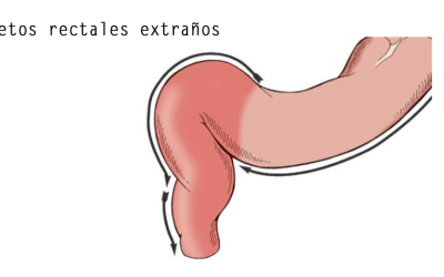Objetos rectales extraños o cosas encontradas en el ano de la gente
