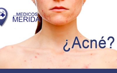 Acné no solo en la cara