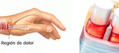 Tendinitis de De Quervain