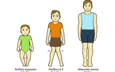 Separación anormal de las piernas en niños