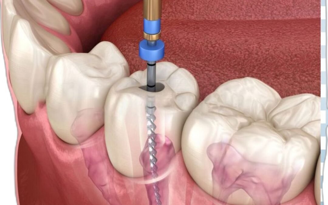 ¿Qué cuidados se deben tener después de una endodoncia y cómo se trata el dolor?