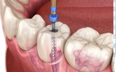 ¿Qué cuidados se deben tener después de una endodoncia y cómo se trata el dolor?
