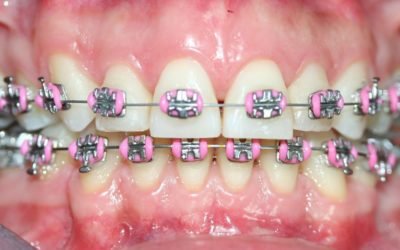 Tipos de tratamientos ortodonticos