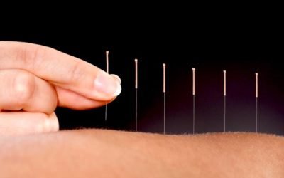 ¿Es buena o mala la acupuntura?