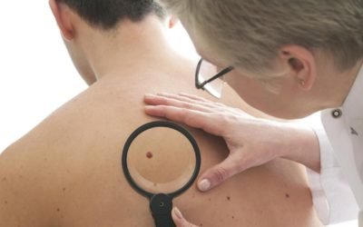 ¿Por qué salen los lunares?