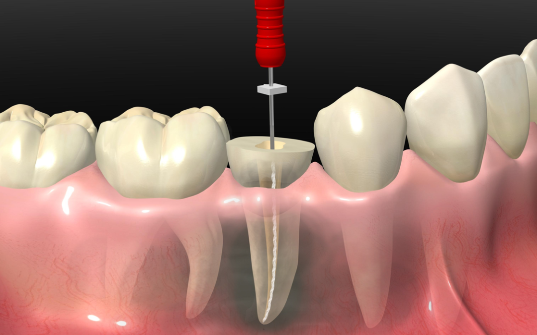 ¿Por qué se hace una endodoncia?