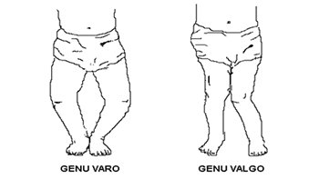 “Genu Valgo” en ortopedia rodillas pegadas o en X
