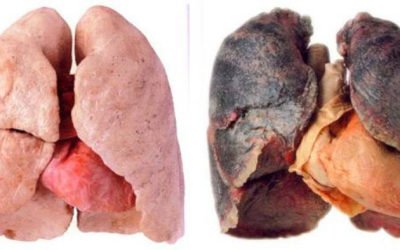 Cáncer Pulmonar