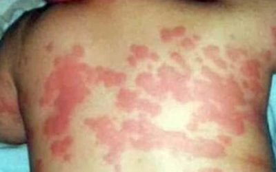 Alergia al protector solar