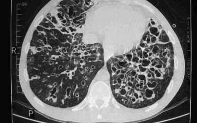 Bronquiectasia