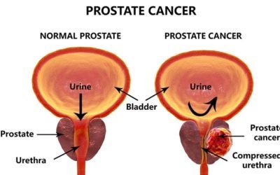 Cáncer de Próstata