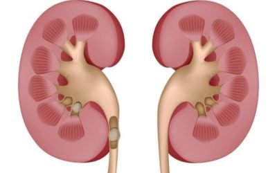¿Cuáles son los síntomas de las piedras de los riñones?