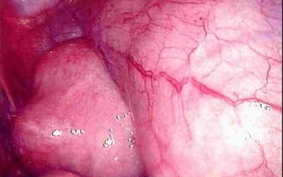 Las varices uterinas o síndrome de congestión pélvica