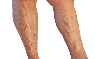 Tratamientos no invasivos para eliminar las varices por ANGIÓLOGOS