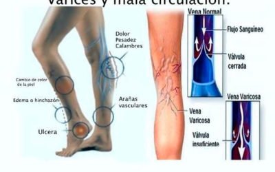 Cirugía ambulatoria de varices