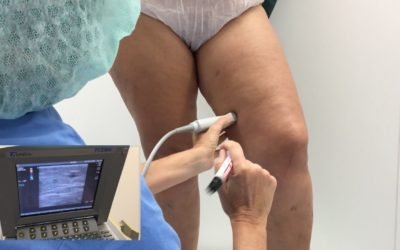 ¿Varices? Elimínelas con radiofrecuencia