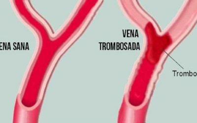 Trombosis: qué es y cómo prevenirla