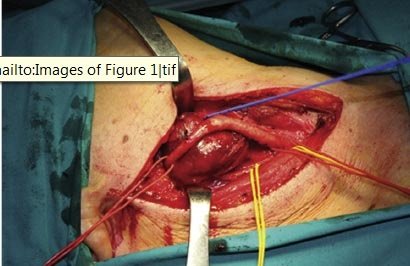 Cirugía de la arteria carótida