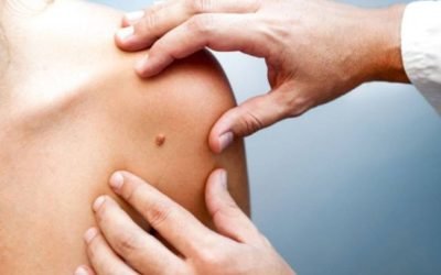 Tratamiento para verrugas: ¿por qué eliminarlas?