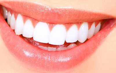 Implantes dentales: cómo mantener una correcta limpieza dental