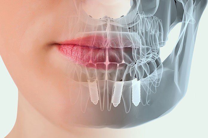 ¿De qué están hechos los implantes dentales y cómo se colocan?