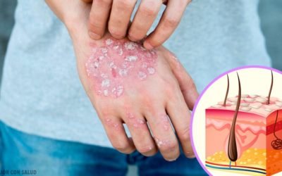 ¿A qué partes del cuerpo afecta la psoriasis?