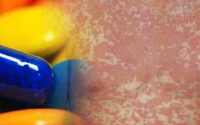 Alergia a los fármacos: aprende a reconocerla